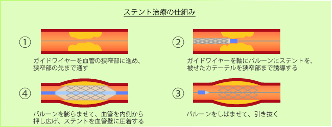 経皮的冠動脈形成術(PCI) の治療方法