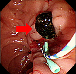 逆行性膵胆管造影　ERCP