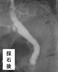 逆行性膵胆管造影　ERCP