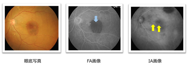 蛍光眼底造影検査