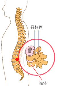 脊柱管狭窄症