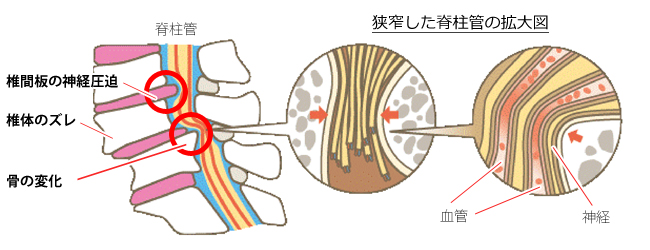 脊柱管狭窄症